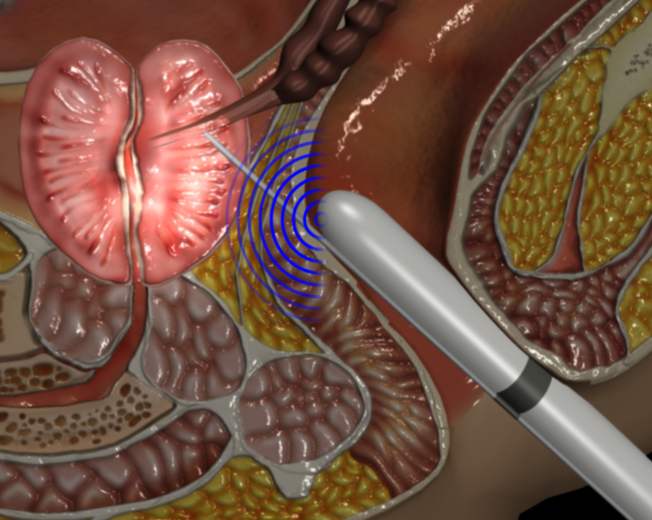 Transrectal biopsy